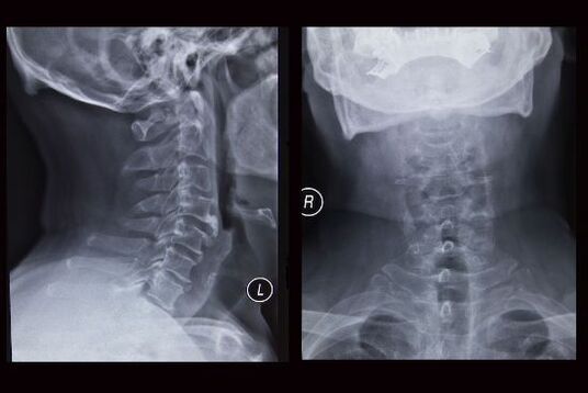 Imaxe de raios X da columna cervical (o paciente ten osteocondrose)