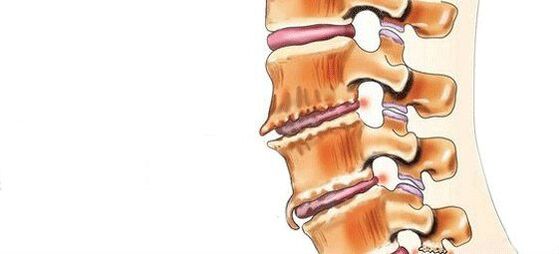 Espondilose destrución de articulacións intervertebrais