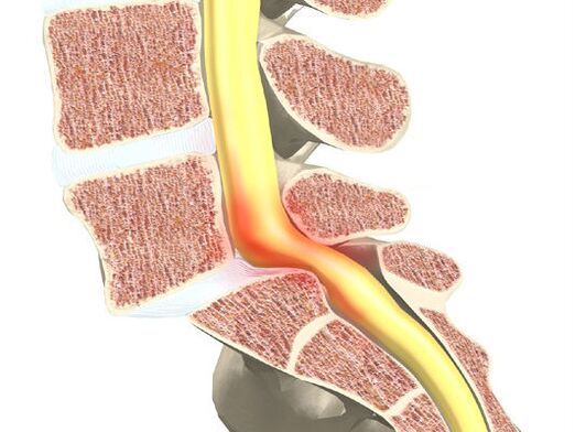 Segmento de motores de sangue para osteocondrose