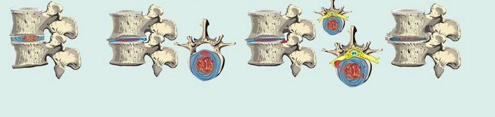 Varias etapas da osteocondrose torácica