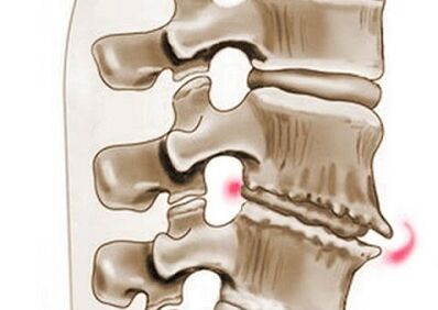 danos ás vértebras na osteocondrose torácica