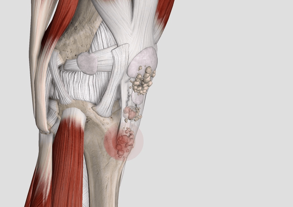 síntomas