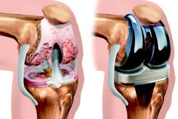 antes e despois da artrose da articulación do xeonllo por artrose