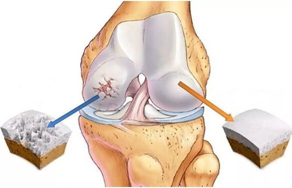 cartilaxe saudable e cartilaxe afectada pola artrose